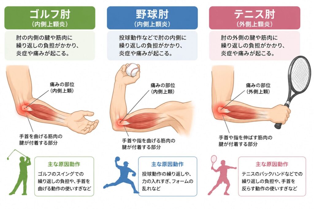 テニス肘と野球肘とゴルフ肘の比較説明図