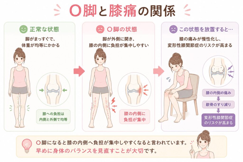 O脚と膝痛の関係を説明したイラスト。正常な脚とO脚を比較し、O脚では膝の内側に負担が集中しやすく、膝痛や変形性膝関節症につながる可能性があることをわかりやすく解説している。