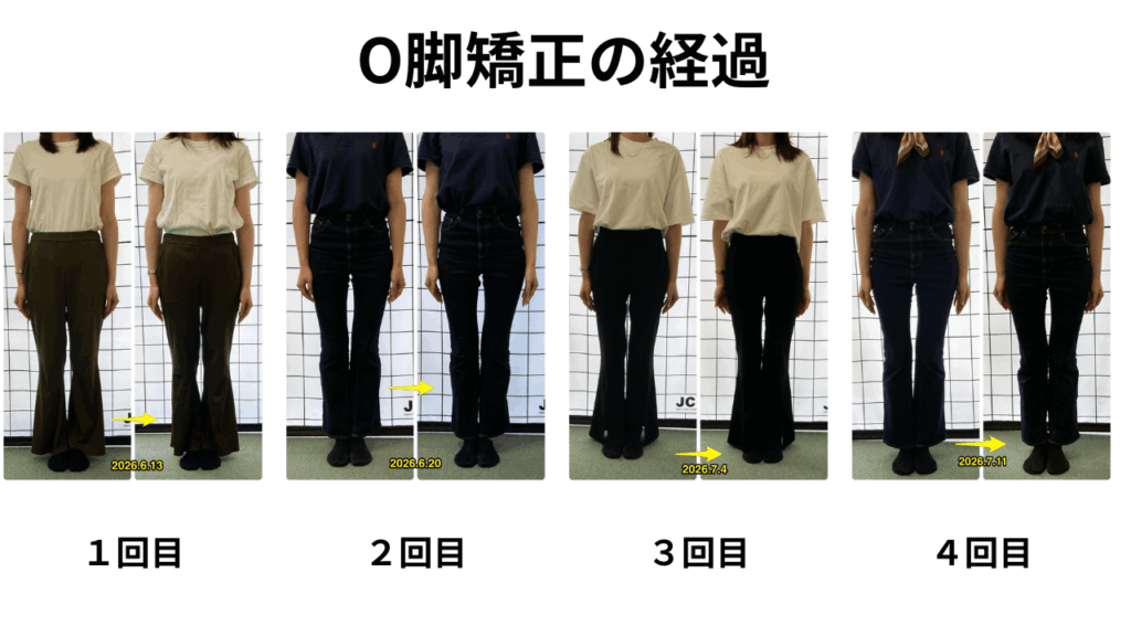 実際のO脚のクライアントさんの写真（１～４回の経過写真）