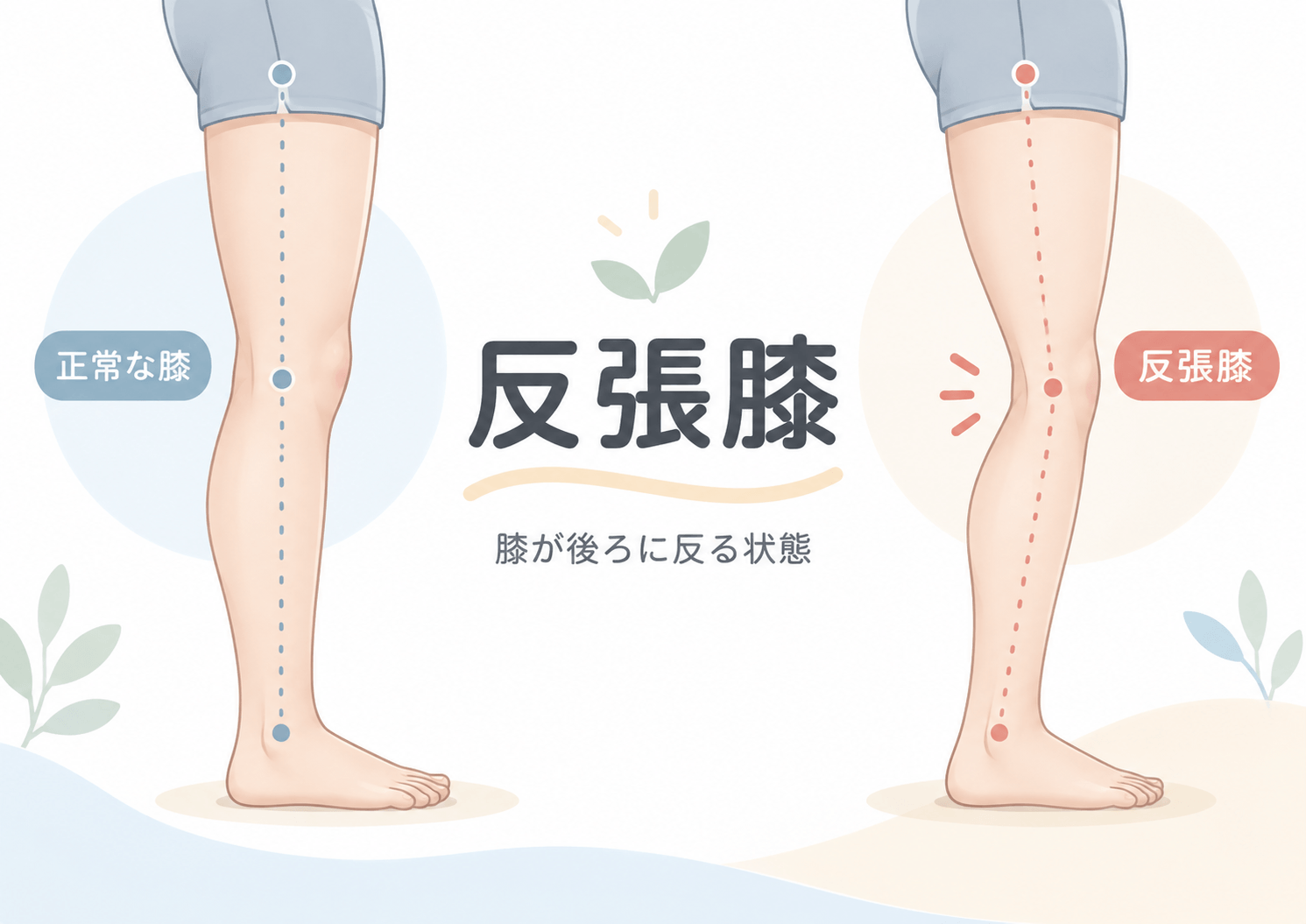 反張膝で膝が後ろに反っている状態を正常な膝と比較したイラスト