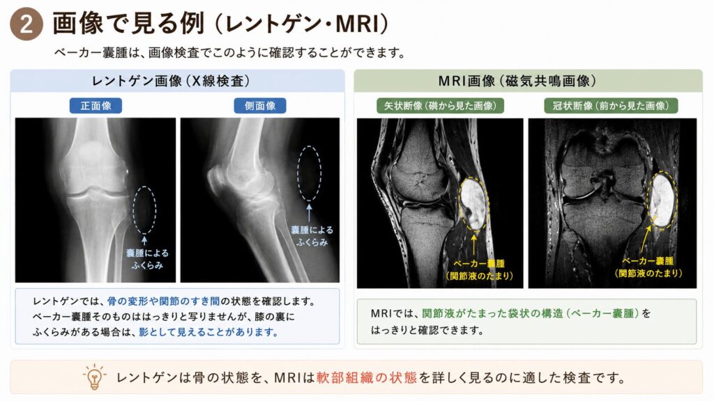 ベーカー嚢腫による膝裏のグリグリやふくらみを解説した図、レントゲンとMRI